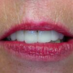 porcelain tooth crowns