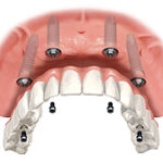 all on 4 dental implants abroad replace a denture with 4 dental implants