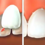What are dental veneers?