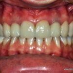 After dental treatment After dental crowns