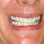 Kelly after her treatment at DentalHoldiay