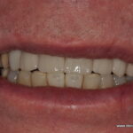 Thomas after his dental treatment
