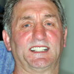 After dental treatment at dental holiday