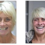 Never be without teeth during treatment