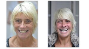 Before dental treatment and picture of client with temporary bridge. Before dental treatment and picture of client with temporary bridge.