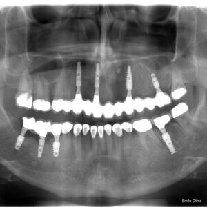 Ian OPG - Dental Xray