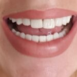 Dental implants changed not only my smile but my whole life!