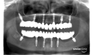 The X ray of Lisa´s teeth AFTER the treatment