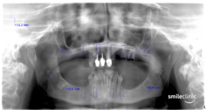 The X ray of Lisa´s teeth BEFORE the treatment