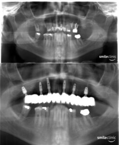 Patient´s X-rays BEFORE and AFTER the treatment