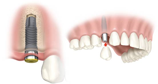 What are dental implants?