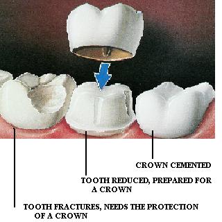 What are crowns?