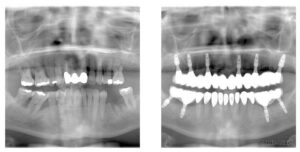 X-rays before the treatment and after the treatment