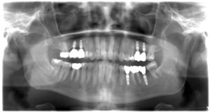 Patient´s X ray AFTER the treatment