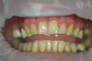 Photo BEFORE treatment with dental implnats and dental crowns