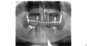An X - ray taken DURING the treatment - temporary dental crowns
