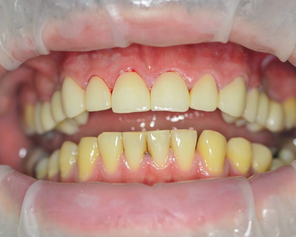 How long after tooth removal can a bridge be fitted? Dental Holiday